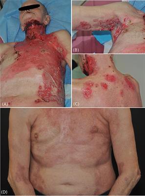 Radiation-Associated Pemphigus Vulgaris in a Patient With Preceding Malignancy: Treatment With Rituximab as a Valuable Option